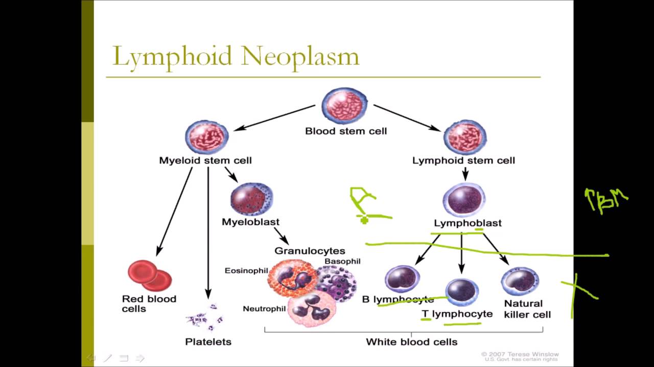 HLS Pathology - Lymphoid Neoplasms ( ALL - CLL ) - YouTube