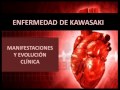 Enfermedad de Kawasaki - Manifestaciones y Evolución clínica