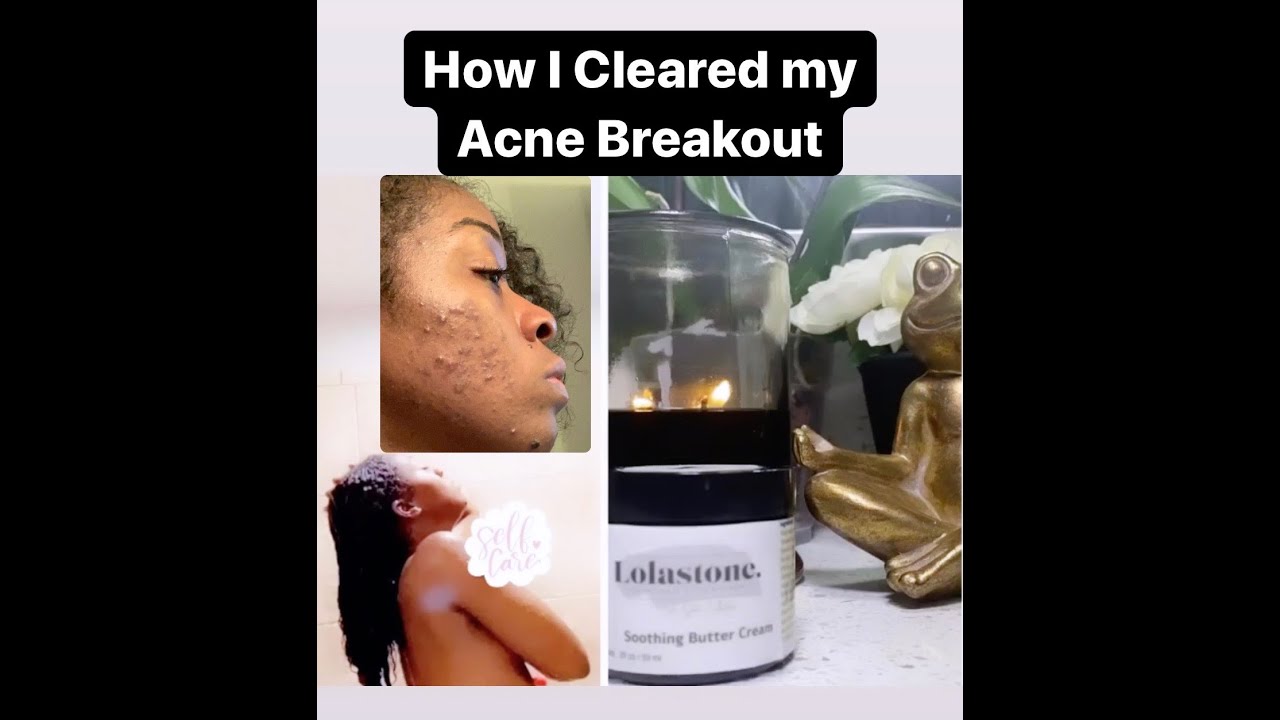 How I Cleared my Acne Breakout using DIY Products - YouTube
