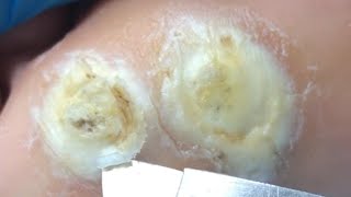 The two huge plantar warts resemble demonic eyes! Let's remove them【Athlete’s foot pedicure】