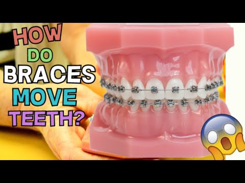 How do braces move and straighten your teeth? Metal Braces VS Invisalign