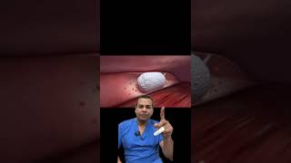 How the Varithena procedure is done- Dr. Gupta