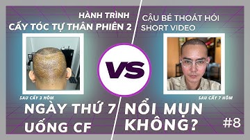 NGÀY THỨ 7 CẤY TÓC TỰ THÂN UỐNG CÀ PHÊ CÓ NỔI MỤN KHÔNG #8 l HÀNH TRÌNH CẤY TÓC