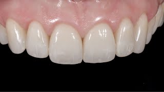 Aesthetic veneer cementation with Ena Cem HV - clinical case by Dr. Lorenzo Vanini screenshot 5