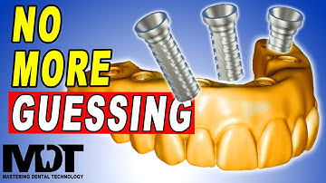 Cut TI Base Height Digitally in All On 4 [ Exoxad Tutorial for Screw Retained Implants ]