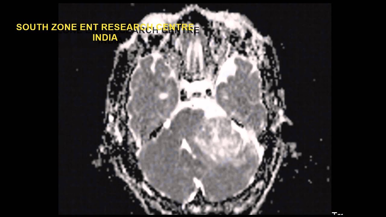 MRI ACOUSTIC NEUROMA YouTube