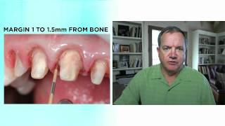 Anterior Temporaries, Part 1