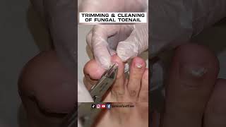 TRIMMING &amp; CLEANING OF FUNGAL TOENAIL 2023 [ SATISFYING ] BY MISS FOOT FIXER