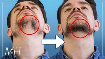 Hoe je snel van je kale baard afkomt!