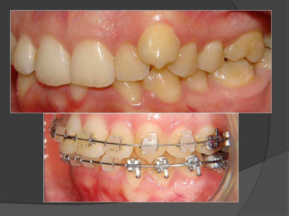 Amazing Deep Bite Correction with Clear Braces Orthodontist! YouTube