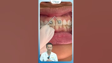 Hé Lộ Gắn Mắc Cài Niềng Răng Đúng Cách | Bác Sĩ Yên