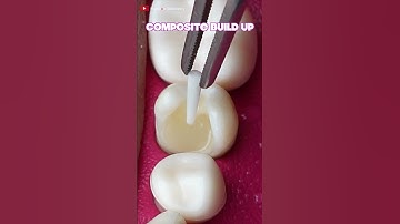 Onlay Teeth Restoration #dentistteeth #satisfying