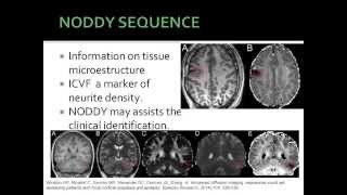 Fcd-Focal Cortycal Dysplasia
