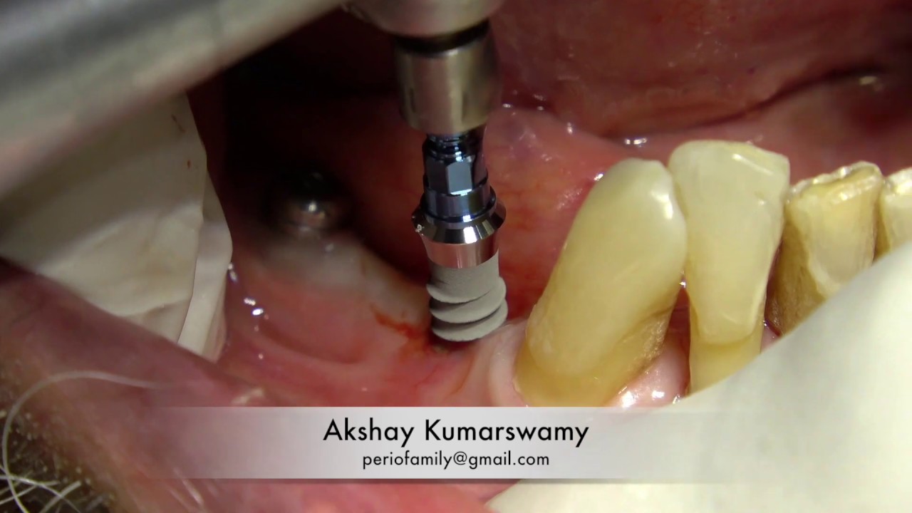 Straumann Tissue Level Implant with prosthesis YouTube