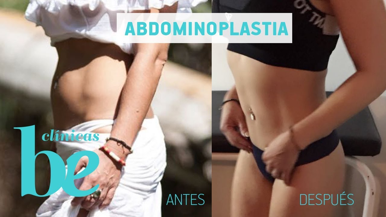 Abdominoplastia . Mi experiencia y resultados | Clínicas Be