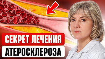 ВРЕДЕН ЛИ ХОЛЕСТЕРИН? Всё об атеросклерозе, инсульте и инфаркте