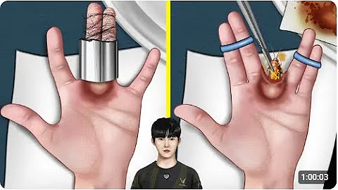 ASMR Animation Help Chovy Remove cockroach from finger gap WOW Brain Hospital 1080p