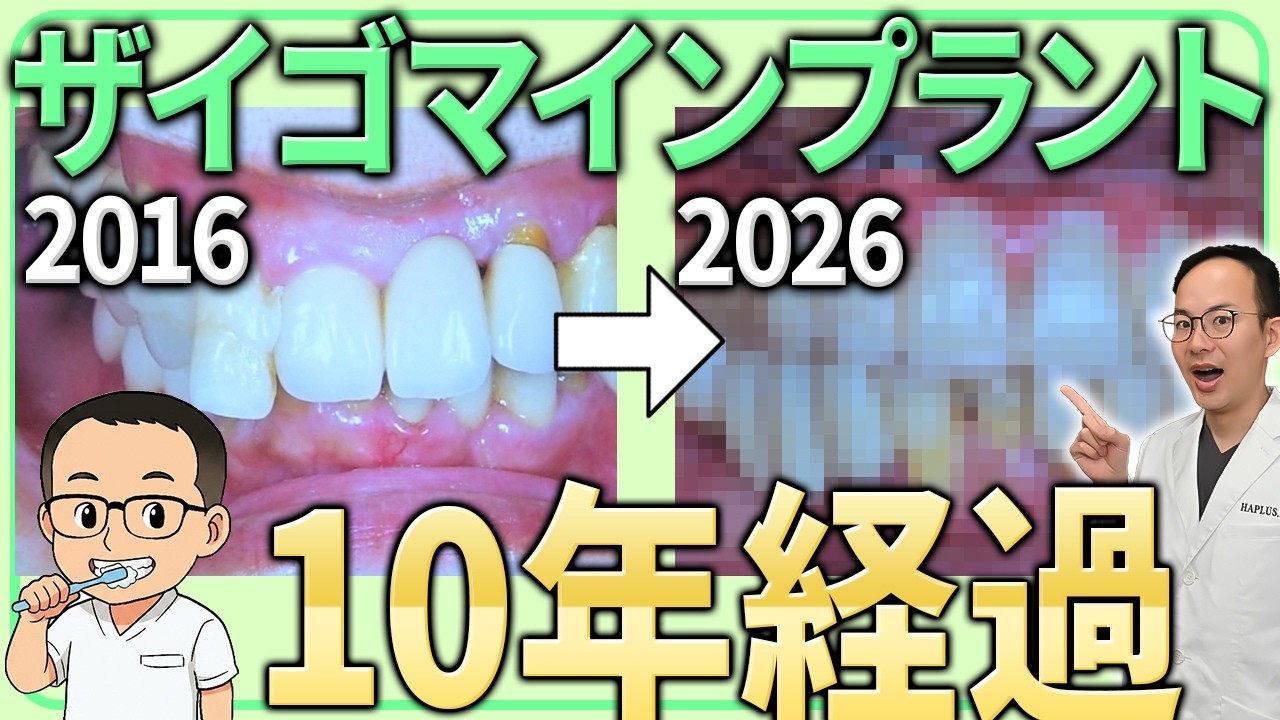 ザイゴマインプラントを症例とともに徹底解説します!長期経過した症例やトラブルがあった際の対応などインプラントのプロがお話しします