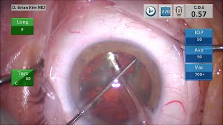 TBWTDCS #66: Moderate Lens Density, PC Fibrosis, Double Chop, Cross Chop, Mechanical Fracturing