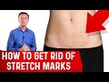 How To Get Rid of Stretch Marks After Pregnancy? - Dr.Berg