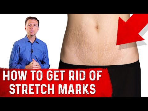 How to Get of Rid Stretch Marks After Pregnancy