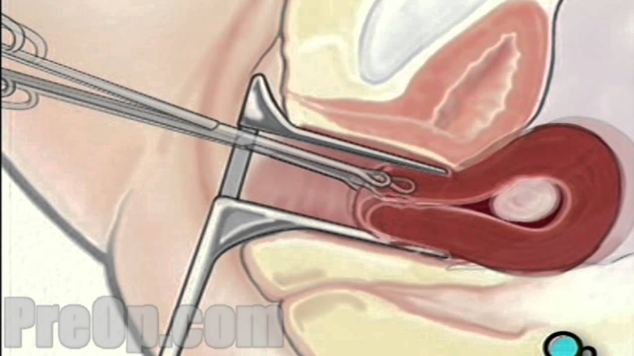 Myomectomy Vaginal Fibroid Removal Surgery PreOp® Patient Education HD -  YouTube