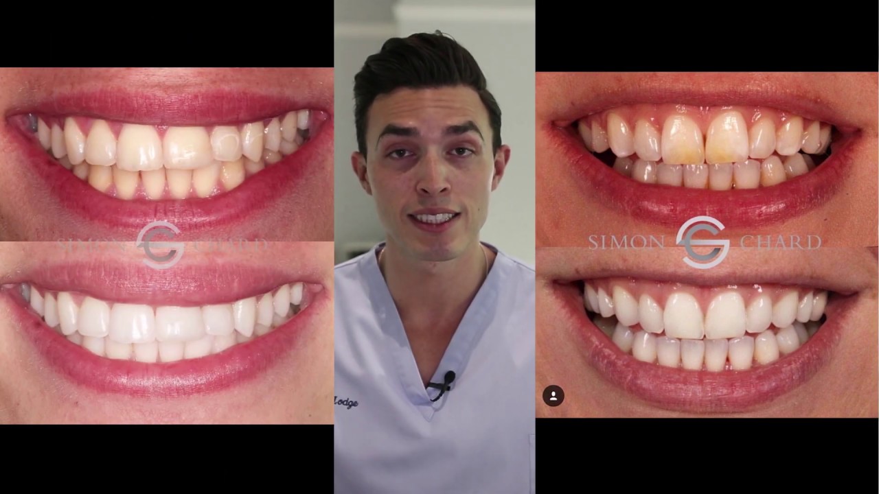 3 Simple Ways To Get Whiter Teeth A Cosmetic Dentist's Advice! YouTube