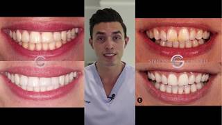 3 Simple Ways To Get Whiter Teeth - A Cosmetic Dentist's Advice!