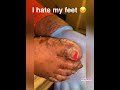 Dead man feet psoriasis removal  meet jakai 