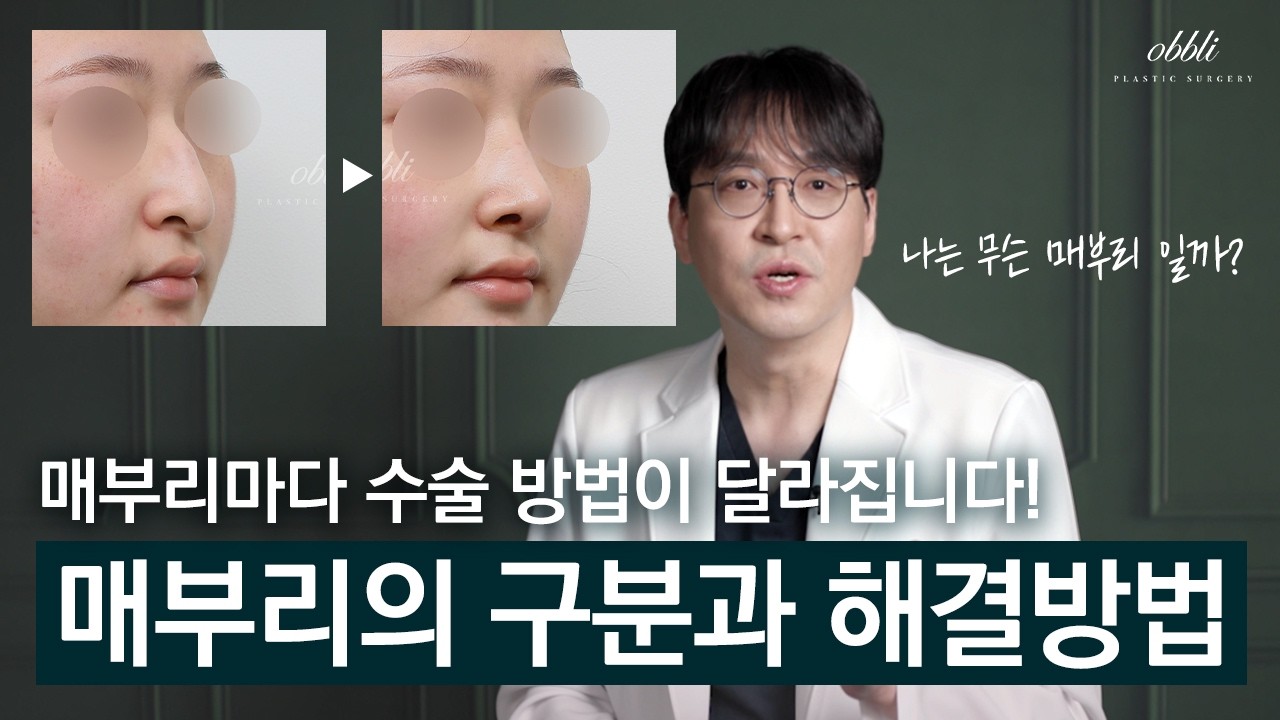 매부리에도 종류가 있습니다. 매부리코의 구분과 올바른 수술 방법