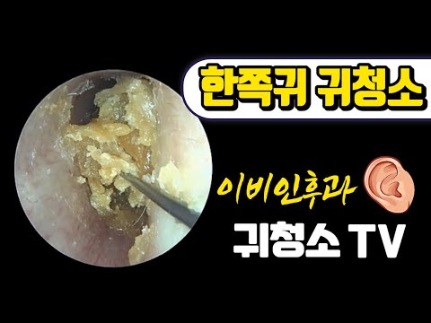 한쪽귀 귀청소 (耳垢掃除)