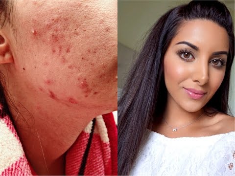 HOW I CURED MY CYSTIC ACNE NATURALLY! | 5 BEST TIPS