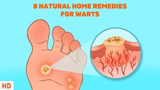 8 Surprising Home Remedies for Warts - Get Rid of Them Naturally! screenshot 3