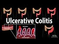 Ulcerative Colitis: Pathophysiology, Symptoms, Risk factors, Diagnosis and Treatments, Animation.