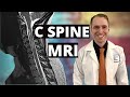 Neurologist Reviews Cervical Spine MRI [Multiple Sclerosis with Enhancing Lesions]