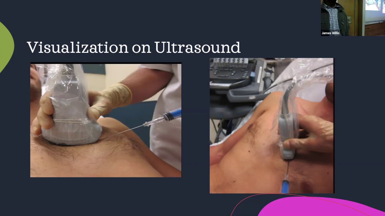 Dr Nonez   Pericardiocentesis