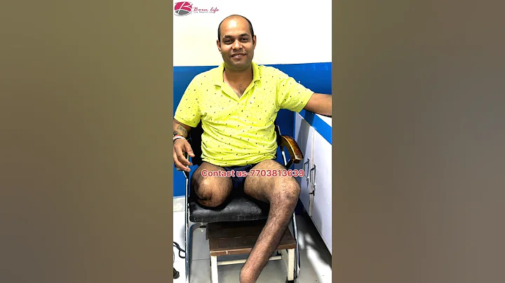 Right Above Knee and Left Below Knee  Prosthetic Leg |Nakli Tang | #artificiallimb #ossur #3r80