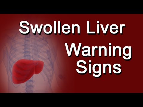Swollen Liver Warning Signs