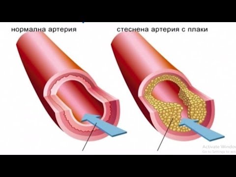 Аадемия Здравословно: Болест на малките съдове на мозъка