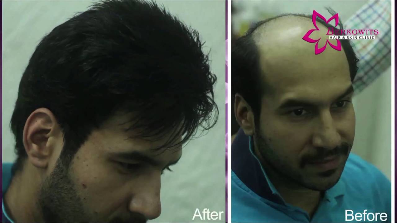 Hair Replacement Review For Berkowits By Sherry Sethi | Must Watch! -  YouTube
