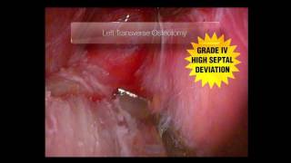 Download Micro-rhinoplasty Transverse Osteotomy Video MP3 Micro-rhinoplasty Transverse Osteotomy