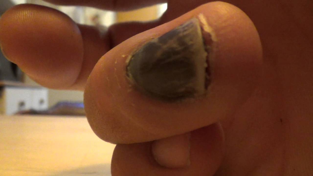 What should I do my big toe nail is about to fall off | FindATopDoc