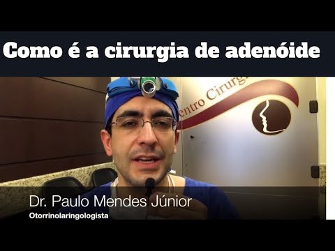 Vídeo: Remoção De Adenóides Em Crianças: Como é Removida, Vale A Pena Fazer?