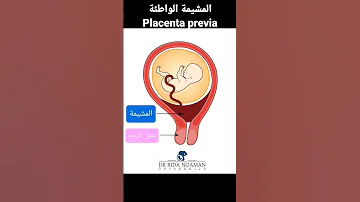 المشيمة الواطئة ذات الارتكاز المعيب Placenta Previa 