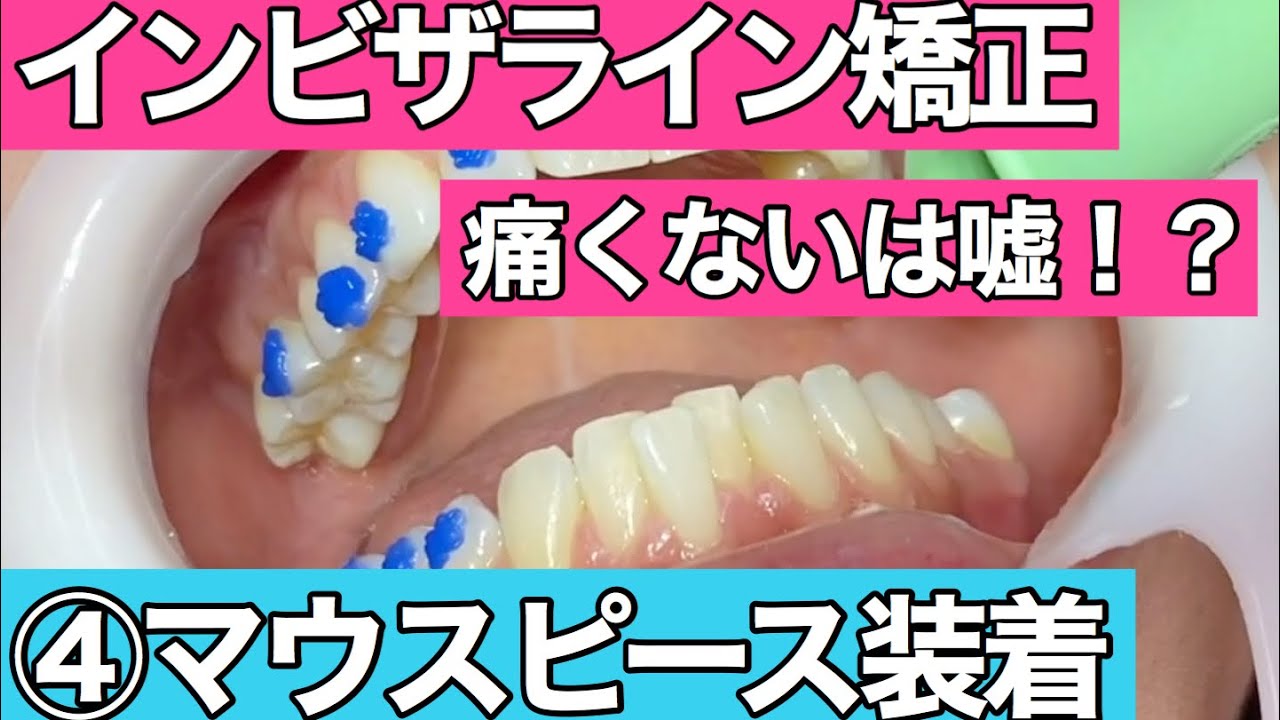 ④やっとインビザライン矯正装着！歯医者での処置内容はこんな感じ！
