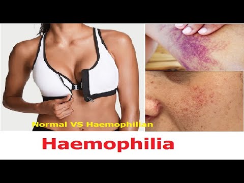 Haemophilia