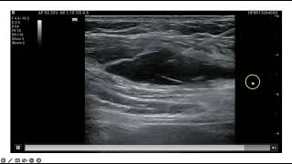 Ultrasound Guided Serratus Anterior Block