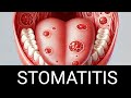Stomatitis /Mouth ulcer मुंह के छाले ( Definition,Types, Pathophysiology and Treatment)