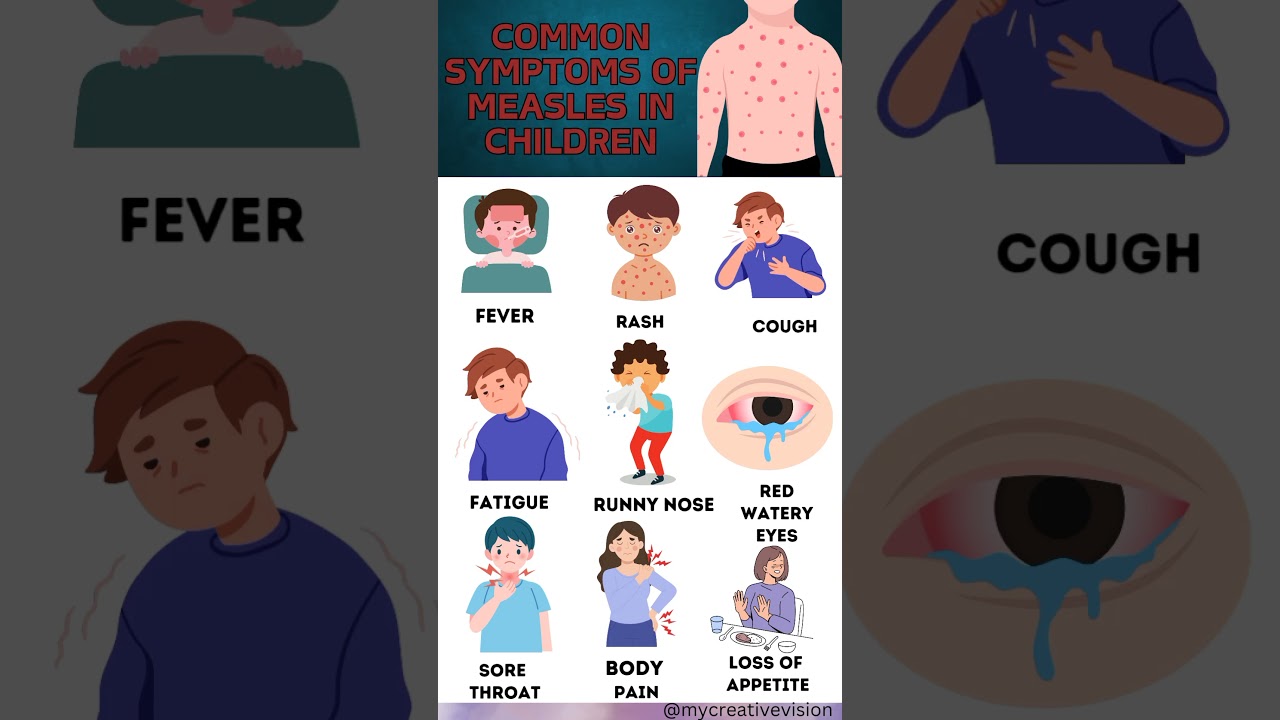 common symptoms of measles in children. # measles