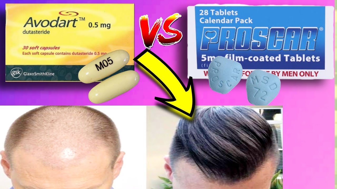 مقارنة الفيناسترايد بالدوتاسترايد لعلاج الصلع الوراثي عند الرجال - Finasteride VS Dutasteride